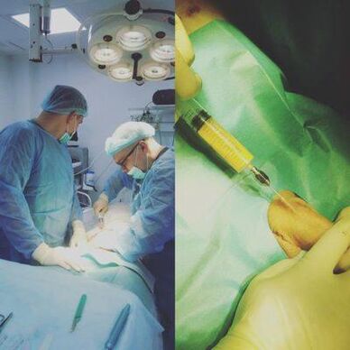 Îngroșarea penisului este posibilă cu ajutorul intervenției chirurgicale